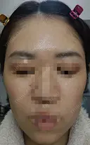 肌育注射（ジュベルックなど） LA MER CLINIC DAY 1 サムネイル用