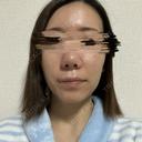 その他（鼻） / 軟骨移植 / ワシ鼻修正・ハンプ切除 / 真皮移植 LUHO（ルホ）美容外科 DAY 152 サムネイル用