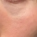 その他（目元） 品川スキンクリニック広島院 DAY 3 サムネイル用