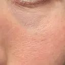 その他（目元） 品川スキンクリニック広島院 DAY 4 サムネイル用