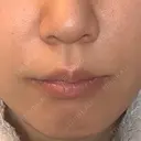 鼻翼基部形成（貴族手術） / ヒアルロン酸注入（鼻翼基部） ルラ美容クリニック 福岡天神院 AFTER サムネイル用