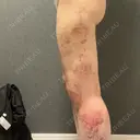 脂肪吸引（脚） GAYA body design clinic DAY 8 サムネイル用