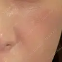 その他（肌） 美容皮膚科エルムクリニック 大阪院 DAY 4 サムネイル用