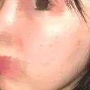 ピーリング（ニキビ・毛穴） / 光治療（フォトフェイシャルなど） ルラ美容クリニック 横浜院 AFTER サムネイル用