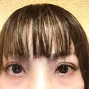 二重埋没 品川スキンクリニック沖縄院 DAY -324 サムネイル用