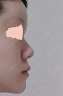 隆鼻術 / 鼻尖形成（切開） / 鼻中隔延長（切開） / 軟骨移植 / 骨切幅寄せ / 鼻孔縁挙上 / 鼻翼基部形成（貴族手術） / 鼻柱下降・鼻唇角形成（猫手術） WOM CLINIC GINZA （ワム クリニック ギンザ） DAY 16 サムネイル用