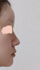 隆鼻術 / 鼻尖形成（切開） / 鼻中隔延長（切開） / 軟骨移植 / 骨切幅寄せ / 鼻孔縁挙上 / 鼻翼基部形成（貴族手術） / 鼻柱下降・鼻唇角形成（猫手術） WOM CLINIC GINZA （ワム クリニック ギンザ） DAY 16 サムネイル用