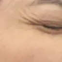 ボトックス（目尻） PRO CLINIC プロクリニック 銀座院 AFTER サムネイル用
