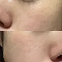 ピーリング（ハリ・ツヤ） / ルメッカ ルラ美容クリニック 札幌本院 AFTER サムネイル用