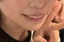 糸リフト / 脂肪吸引（顔） Wing clinic 豊中駅前院 AFTER サムネイル用