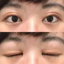 二重切開 / 目頭切開 / ほくろ・いぼ切除（肌） / 上まぶたたるみ取り / 上まぶたの脂肪取り 東京美容外科 銀座院 DAY 56 サムネイル用
