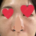 リジュラン Natural Skin Clinic 自由ヶ丘院 DAY 1 サムネイル用