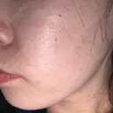 光治療（フォトフェイシャルなど） エイトビューティークリニック 新宿院 AFTER サムネイル用