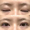 二重埋没 / 上まぶたの脂肪取り アリエル美容クリニック 郡山院 DAY 56 サムネイル用