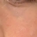 その他（目元） 品川スキンクリニック広島院 DAY 5 サムネイル用