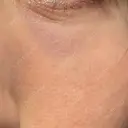 その他（目元） 品川スキンクリニック広島院 DAY 6 サムネイル用