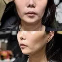 糸リフト PRISM Beauty Clinic 町田院 AFTER サムネイル用