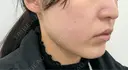 糸リフト / ボトックス（エラ・小顔） / シワ取りボトックス TCB東京中央美容外科 梅田大阪駅前院 DAY 0 サムネイル用