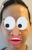 インモード PureMe Skin Clinic（ピュアミースキンクリニック麻布） DAY 1 サムネイル用