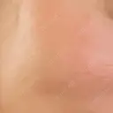 ピコスポット 東京シルククリニック 新宿院 AFTER サムネイル用