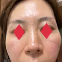 イオン導入 / ピコレーザートーニング（美白・肝斑） / フラクショナルレーザー（毛穴・ニキビ跡） / ピーリング（ハリ・ツヤ） ルラ美容クリニック 広島院 AFTER サムネイル用