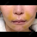 糸リフト / 脂肪吸引（顔） / ジョールファット除去 / ボトックス（エラ・小顔） 新宿美容外科ネビュラクリニック DAY 29 サムネイル用