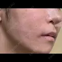 糸リフト / 脂肪吸引（顔） / ジョールファット除去 / ボトックス（エラ・小顔） 新宿美容外科ネビュラクリニック DAY 52 サムネイル用