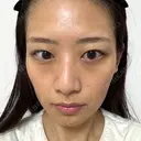 イオン導入 城本クリニック 大阪院 AFTER サムネイル用