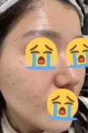 美肌レーザー / LDM・インテンスウルトラ ライズワン美容皮膚科クリニック DAY 0 サムネイル用