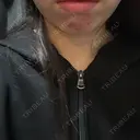 その他（肌） / RF（高周波）たるみ治療 / オンダリフト / その他（輪郭） ライブリークリニック 浜松町院 AFTER サムネイル用