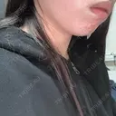 その他（肌） / RF（高周波）たるみ治療 / オンダリフト / その他（輪郭） ライブリークリニック 浜松町院 DAY 0 サムネイル用