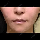 糸リフト / 脂肪吸引（顔） / ジョールファット除去 / ボトックス（エラ・小顔） 新宿美容外科ネビュラクリニック DAY 57 サムネイル用