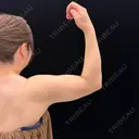 脂肪吸引（二の腕） EMMA CLINIC（エマクリニック） DAY 189 サムネイル用