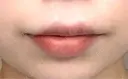 口唇縮小術 博多美容外科/美容皮膚科 ビラビューティークリニック AFTER サムネイル用