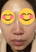 脂肪溶解注射（顔） 上野注入クリニック DAY 1 サムネイル用