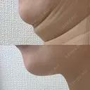 その他（輪郭） 美容皮膚科エルムクリニック 大阪院 DAY 35 サムネイル用