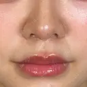 小鼻縮小（切開） / 口角挙上 アリエル美容クリニック 大宮院 AFTER サムネイル用