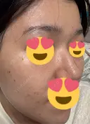 美肌レーザー / LDM・インテンスウルトラ ライズワン美容皮膚科クリニック DAY 1 サムネイル用