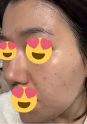 美肌レーザー / LDM・インテンスウルトラ ライズワン美容皮膚科クリニック DAY 1 サムネイル用