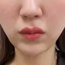 インモード BISIN GINZA CLINIC AFTER サムネイル用