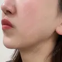 インモード BISIN GINZA CLINIC DAY 2 サムネイル用