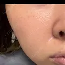 ピーリング（ハリ・ツヤ） / ルメッカ ルラ美容クリニック 横浜院 AFTER サムネイル用