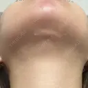 糸リフト / 脂肪吸引（顔） / 水光注射（ハリ・美肌） Wing clinic 豊中駅前院 DAY 57 サムネイル用