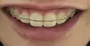 ボトックス（ガミースマイル） 池袋美容クリニック DAY 0 サムネイル用