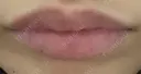 ボトックス（口角） 池袋美容クリニック DAY 0 サムネイル用
