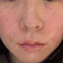 ヒアルロン酸注入（涙袋） / 肌ヒアルロン酸注入（たるみ・シワ改善） / ヒアルロン酸注入（唇） / ヒアルロン酸注入（鼻翼基部） 銀座美容外科クリニック 銀座院 DAY 0 サムネイル用