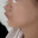 ハイフ（顔） Natural Skin Clinic 自由ヶ丘院 AFTER サムネイル用