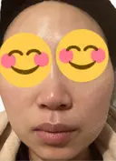 脂肪溶解注射（顔） 上野注入クリニック DAY 2 サムネイル用