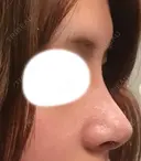 隆鼻術 / 鼻尖形成（切開） / 鼻中隔延長（切開） / 鼻尖縮小 FROM B整形外科 (旧バウム整形外科) DAY 8 サムネイル用