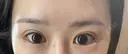 目尻切開 / タレ目形成・グラマラスライン（切開） BIANCA銀座 DAY 31 サムネイル用